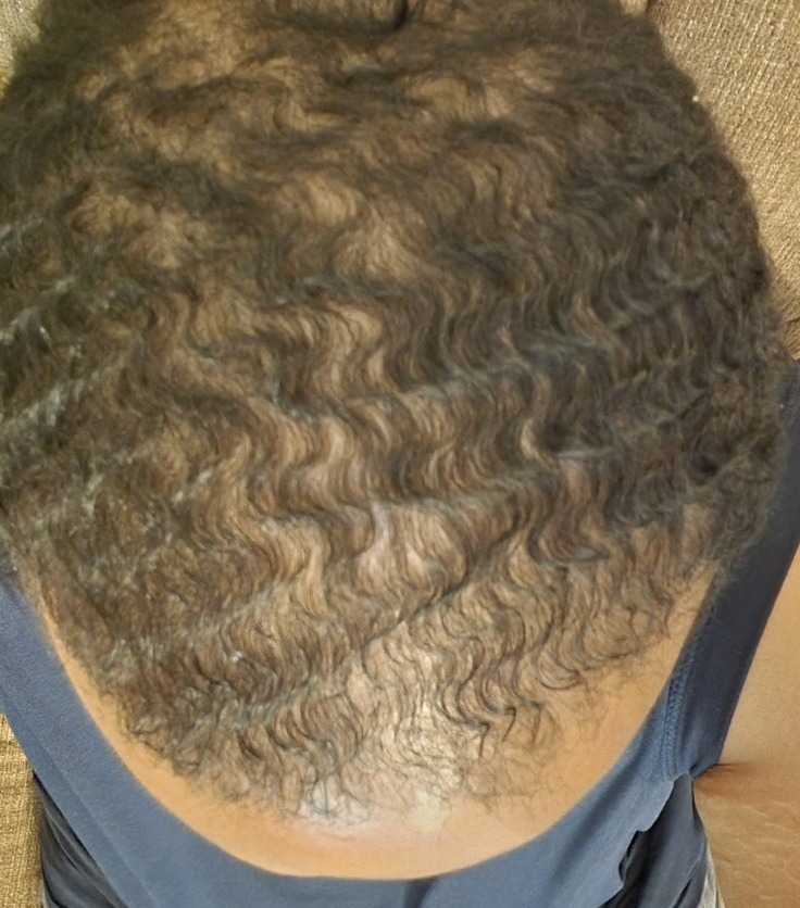 Cardon Real Hair Growth Results Before